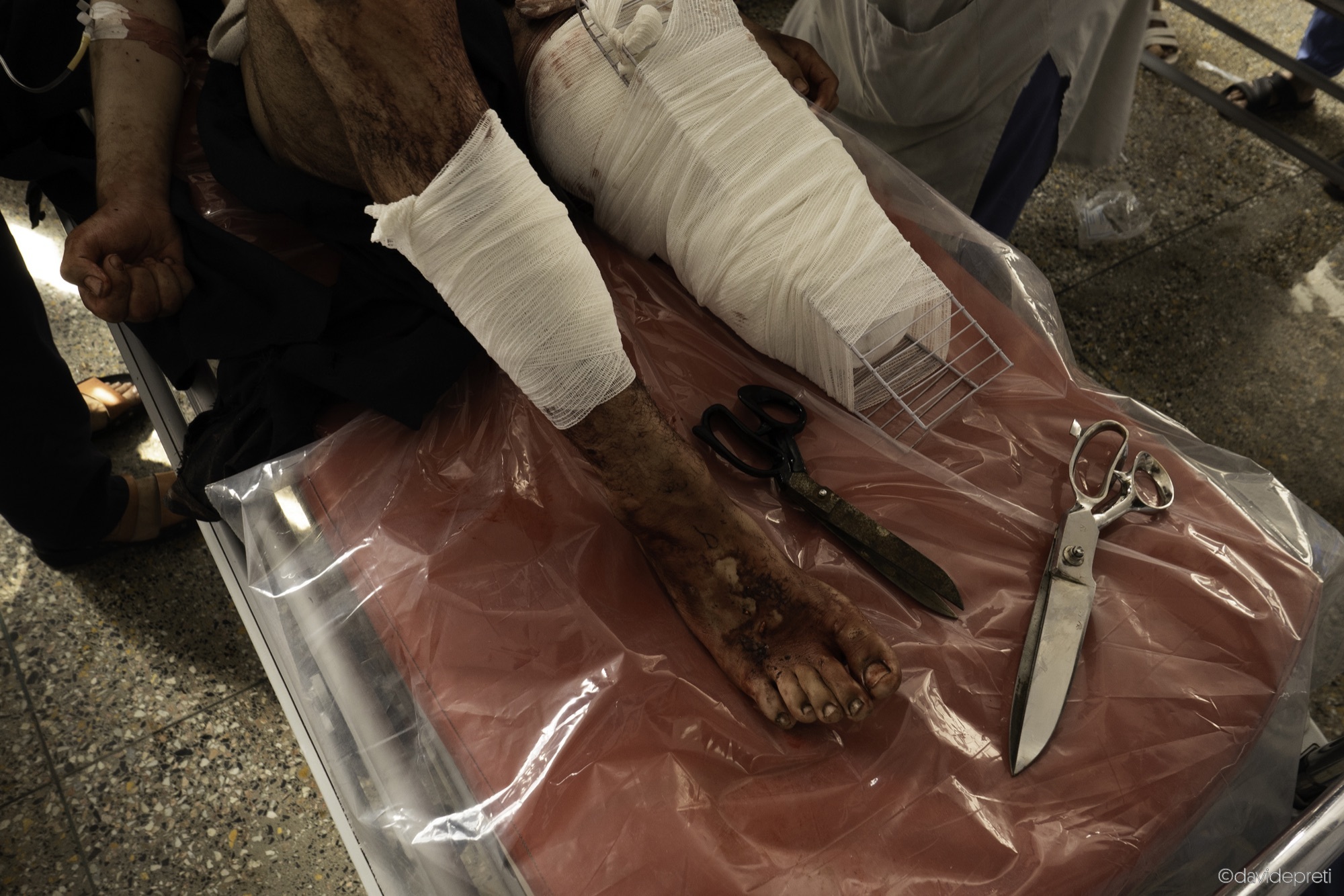 Kabul, Afghanistan — July 13, 2021.

EMERGENCY NGO doctors and nurses stabilize a patient who has suffered numerous injuries including traumatic amputation of the left leg.
