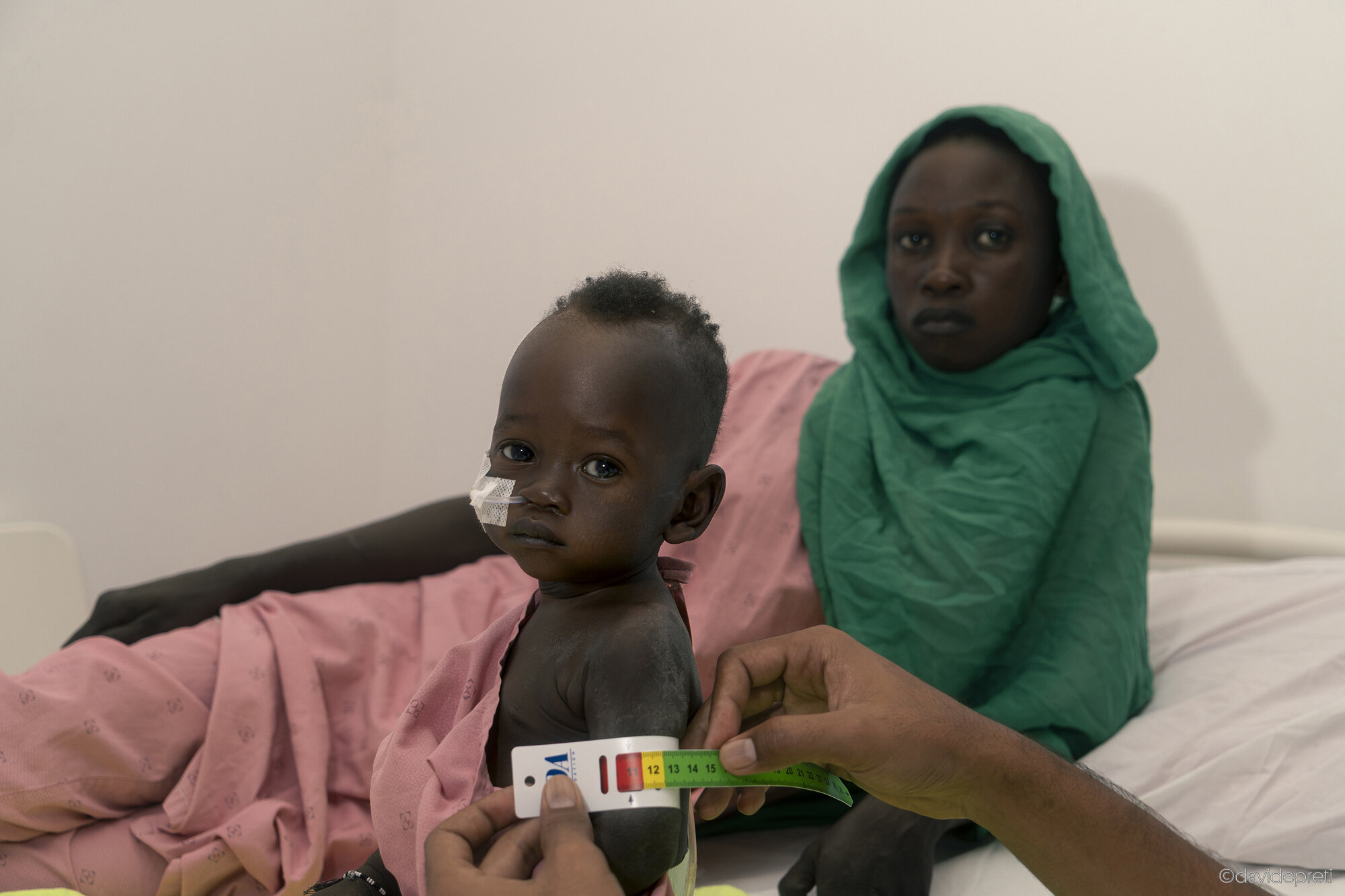 Khartoum, Sudan — November 21, 2025.

M. - 9 months old

He weighs 5,150 grams and is 66 centimeters tall. According to the WHO, a child of his age and height should weigh at least 7,100 grams — he is nearly two kilograms underweight. His mother, H., 18, watches as the nurse measures his mid-upper arm circumference: less than 11 centimeters. The diagnosis is severe acute malnutrition complicated by pneumonia.

At EMERGENCY's Salam Centre pediatric ward, the protocol began immediately: antibiotics and therapeutic milk delivered intravenously every two hours. M. and H. come from a village twenty kilometers outside Khartoum. Before arriving here, a local doctor had dismissed the case, simply telling the mother to eat more. But malnutrition requires gradual clinical rehabilitation; food alone is not enough.

After just one day of treatment, M. has already gained 365 grams. "I didn't think places like this existed in Sudan," H. says. The road ahead remains long: to be considered out of danger, he must gain another kilogram and a half.
